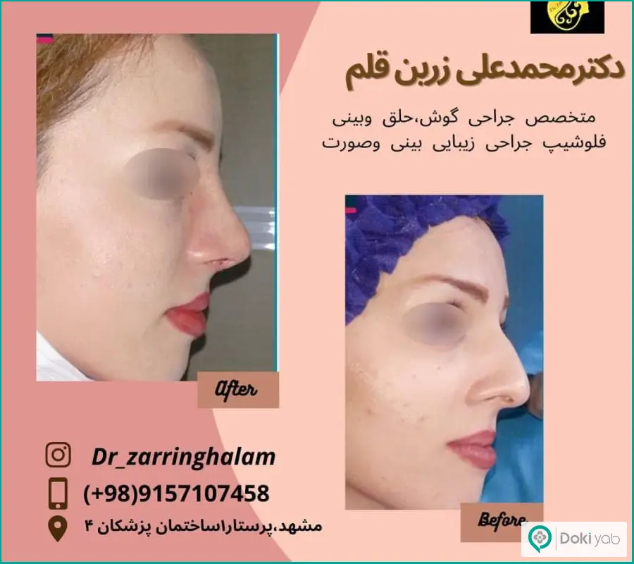 عکس قبل و بعد جراحی بینی شکسته زنانه دکتر محمدعلی زریق قلم