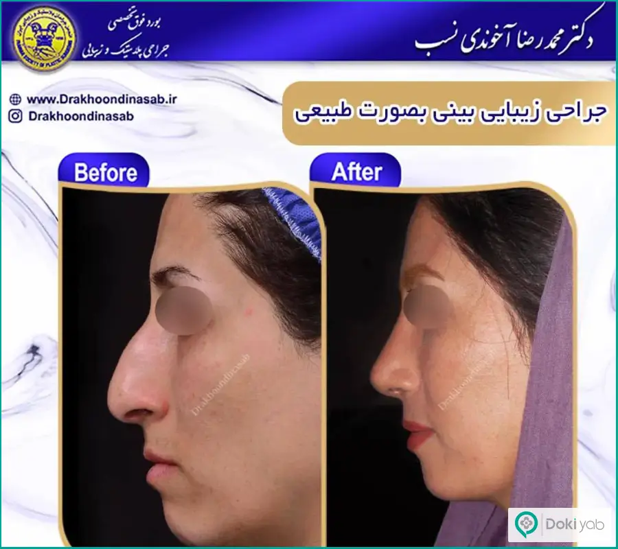 قبل و بعد جراحی شکستگی بینی دخترانه دکتر محمدرضا آخوندی نسب