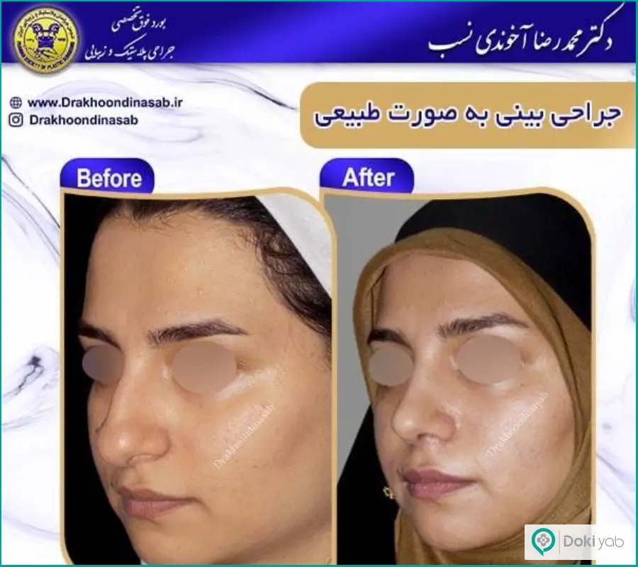 قبل و بعد جراحی دماغ شکسته زنانه دکتر محمدرضا آخوندی نسب