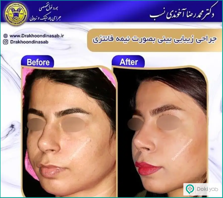 قبل و بعد عمل شکستگی بینی زنانه دکتر محمدرضا آخوندی نسب