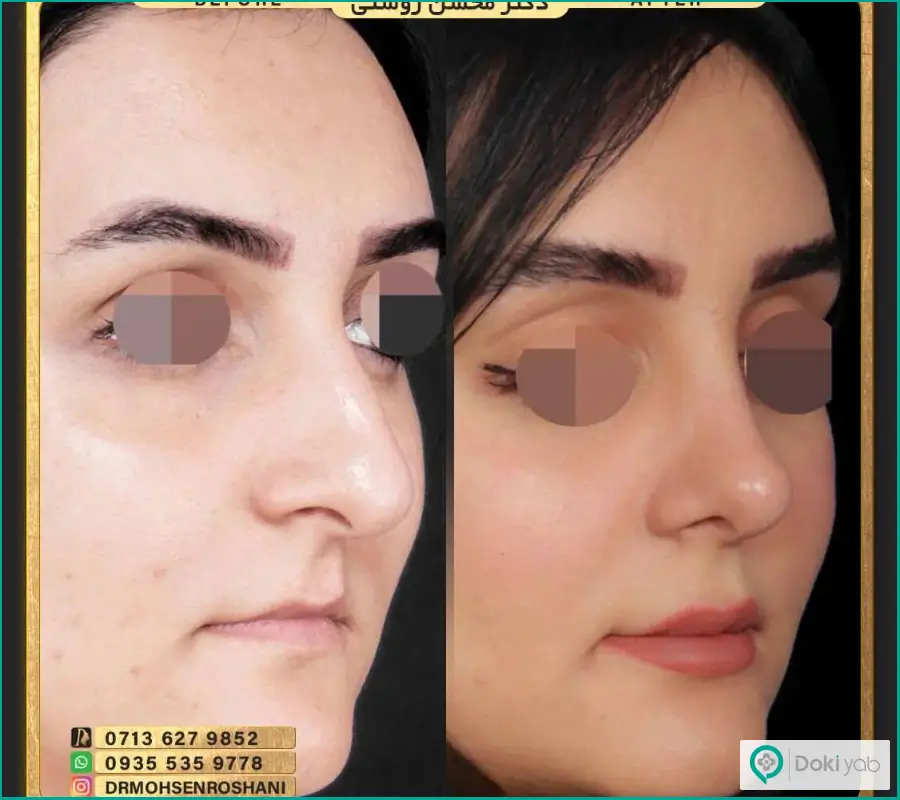 جراحی زیبایی بینی زنانه مدل طبیعی مدرن دکتر محسن روشنی 