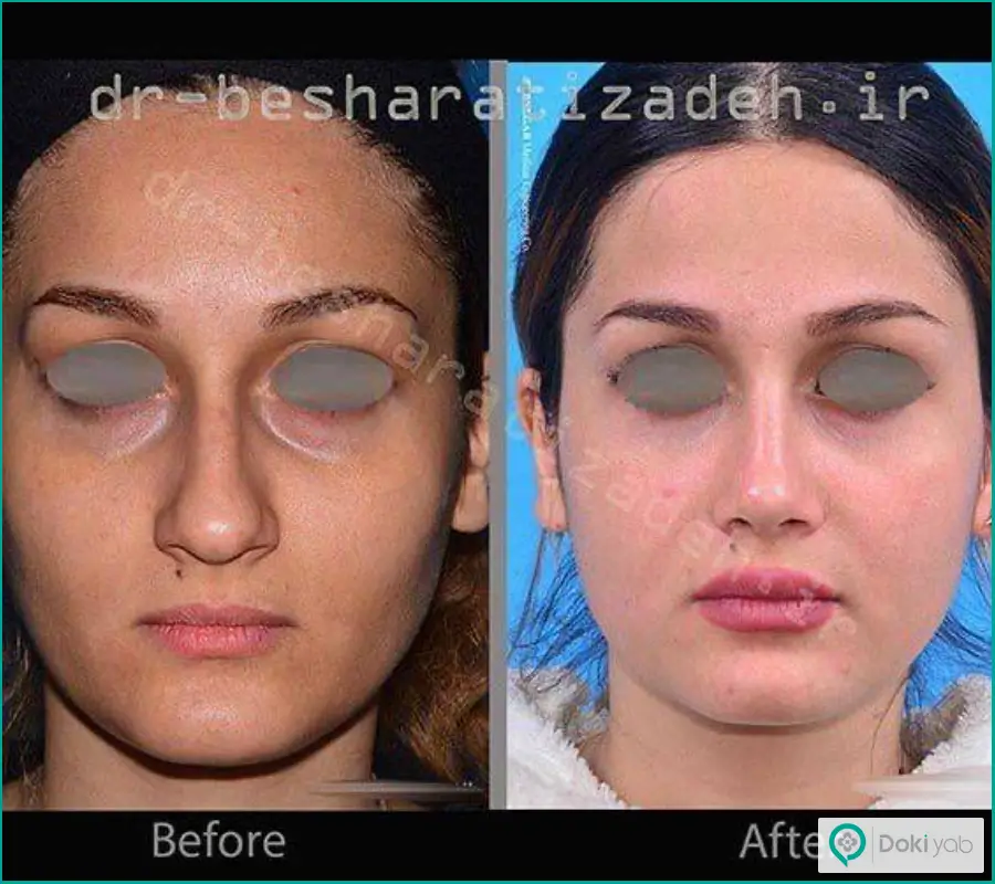 قبل و بعد عمل زیبایی بینی کج دکتر روزینا بشارتی زاده در تهران