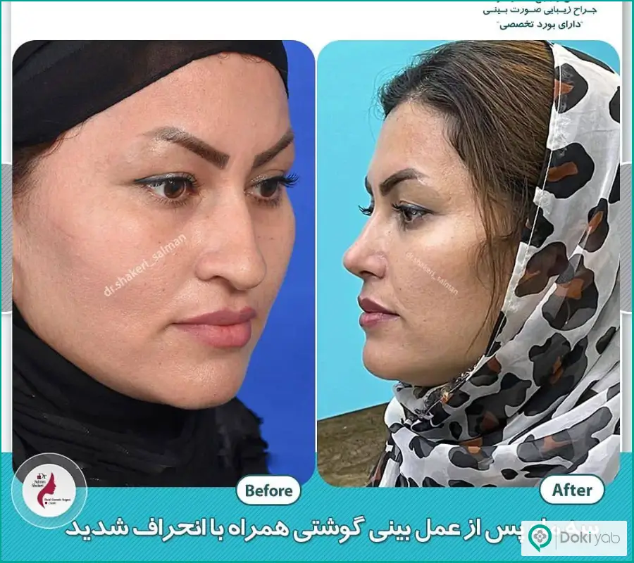 قبل و بعد عمل زیبایی بینی غضروفی زنانه دکتر سلمان شاکری