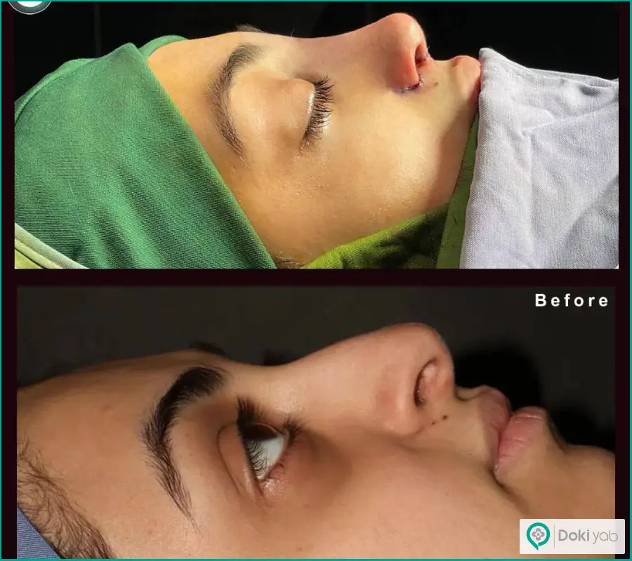 قبل و بعد عمل جراحی بینی نیمه فانتزی نوک گرد زنانه دکتر سلمان شاکری