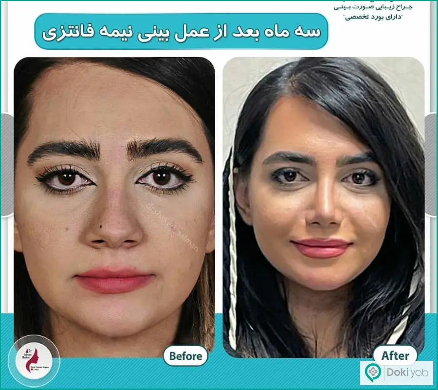 قبل و بعد عمل زیبایی بینی گوشتی زنانه دکتر سلمان شاکری