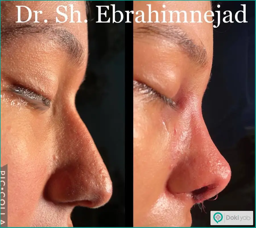 قبل و بعد جراحی بینی استخوانی زنانه مدل فانتزی دکتر شقایق ابراهیم نژاد