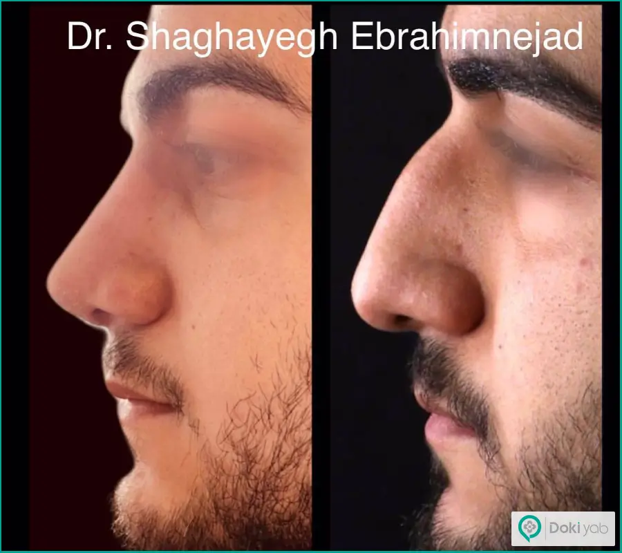 عمل بینی استخوانی مردانه سبک فانتزی دکتر شقایق ابراهیم نژاد