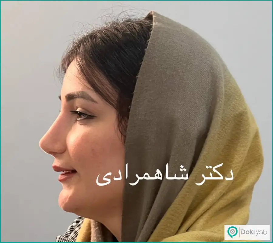 نمونه عمل بینی گوشتی زنانه دکتر شهریار شاهمرادی در شیراز