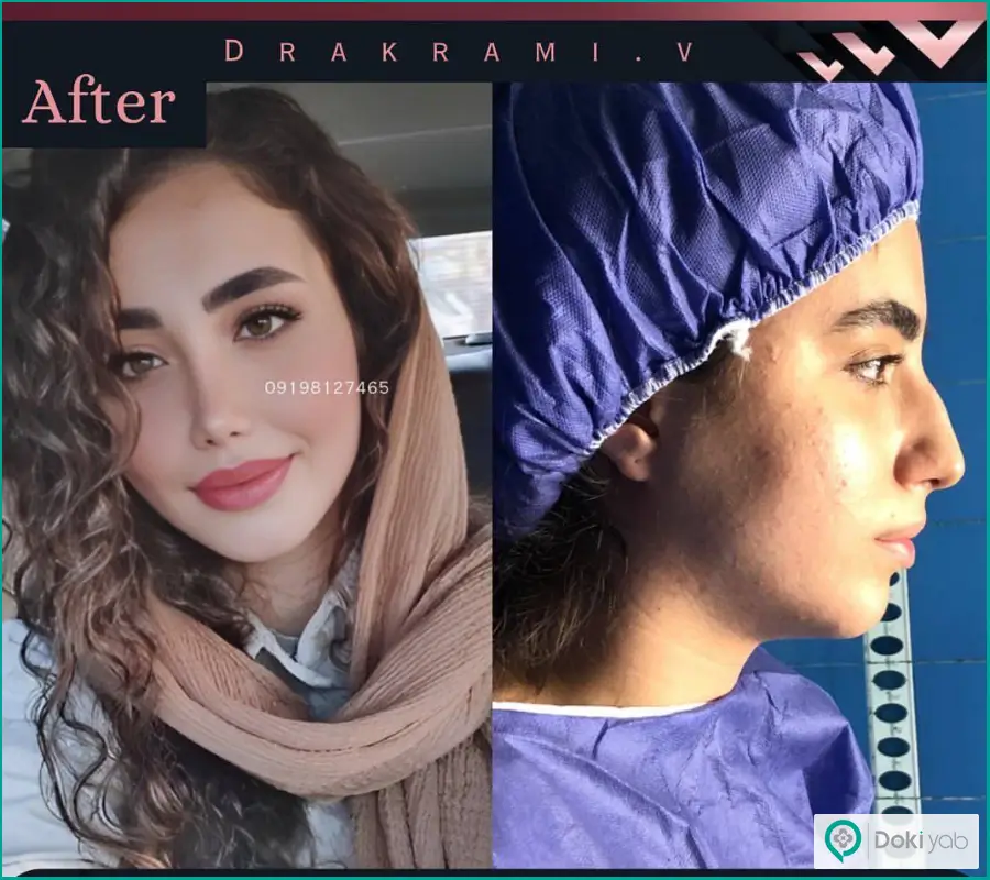 قبل و بعد جراحی بینی عقابی زنانه دکتر شهره اکرمی