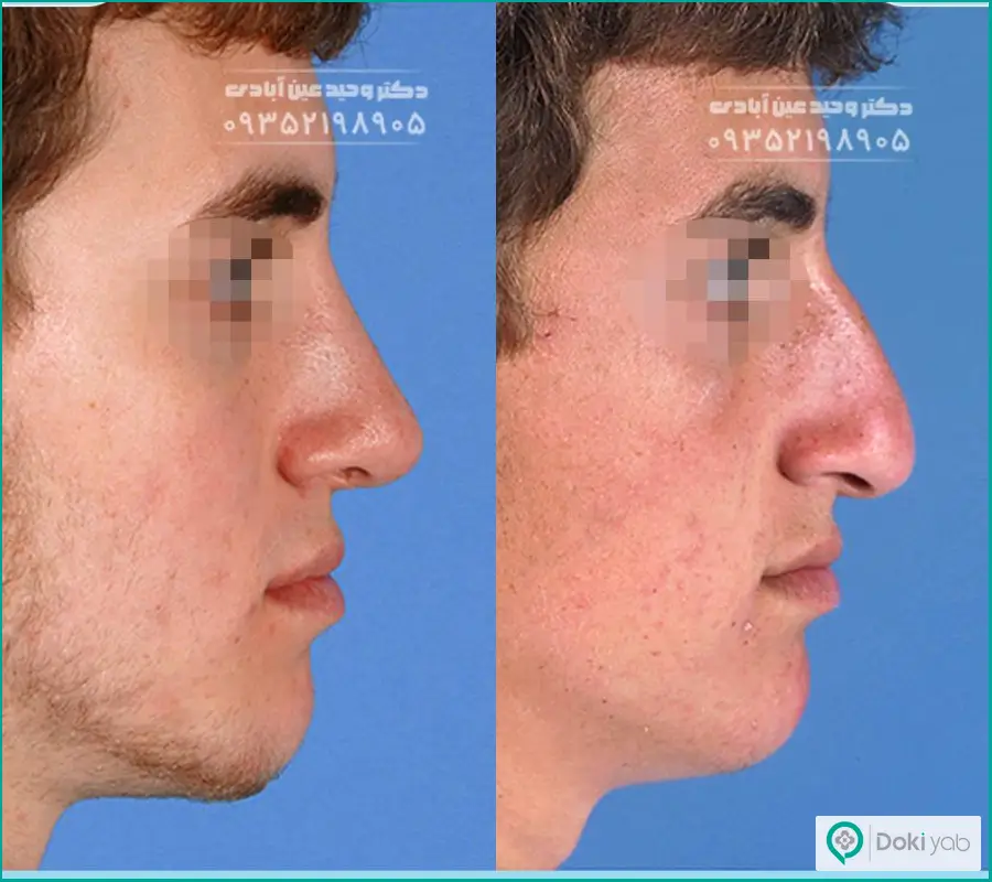 قبل و بعد عمل بینی بزرگ مردانه دکتر وحید عین‌آبادی