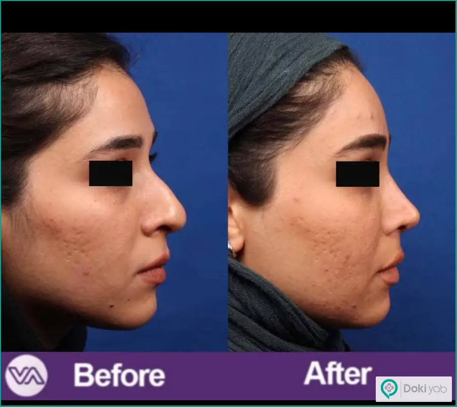 قبل و بعد جراحی بینی بزرگ سبک طبیعی زنانه دکتر ونون آصفی