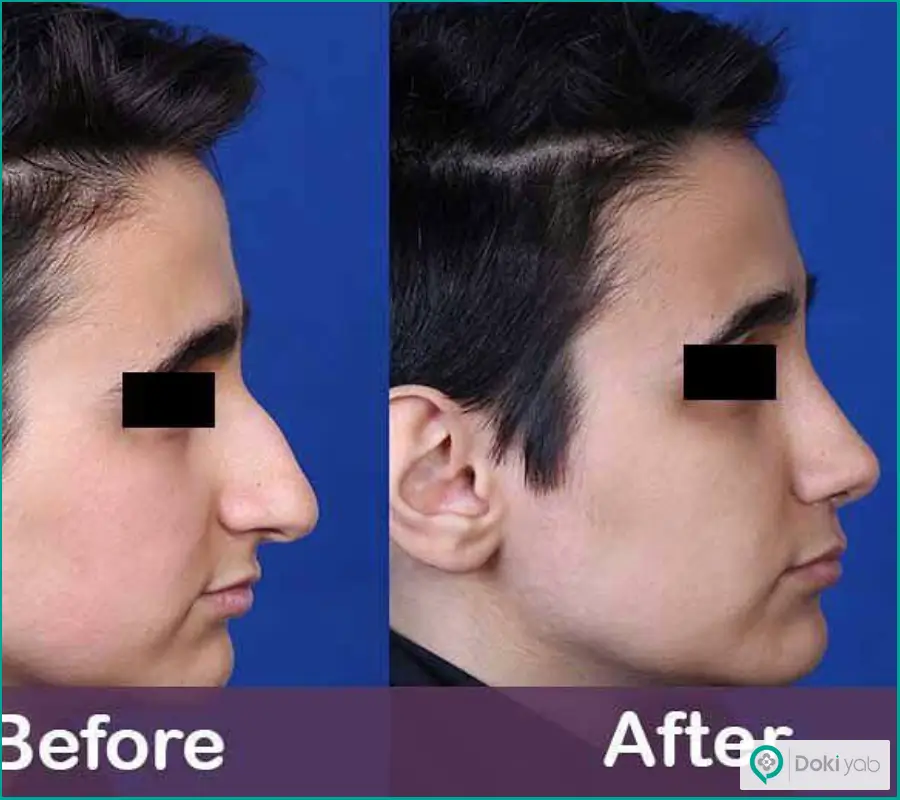 نمونه کار عمل زیبایی شکستگی بینی مردانه دکتر ونون آصفی