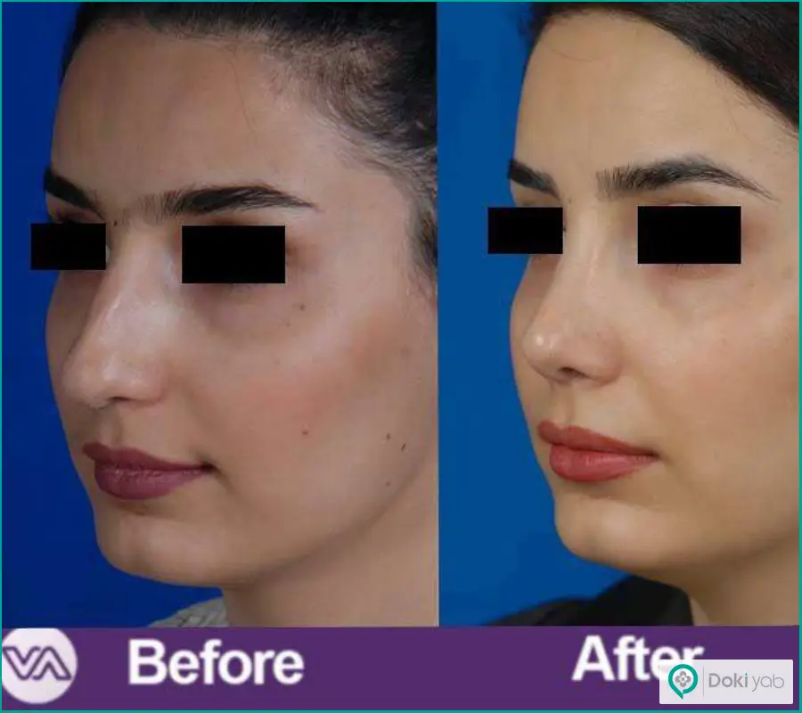 قبل و بعد جراحی زیبایی بینی گوشتی زنانه دکتر ونون آصفی