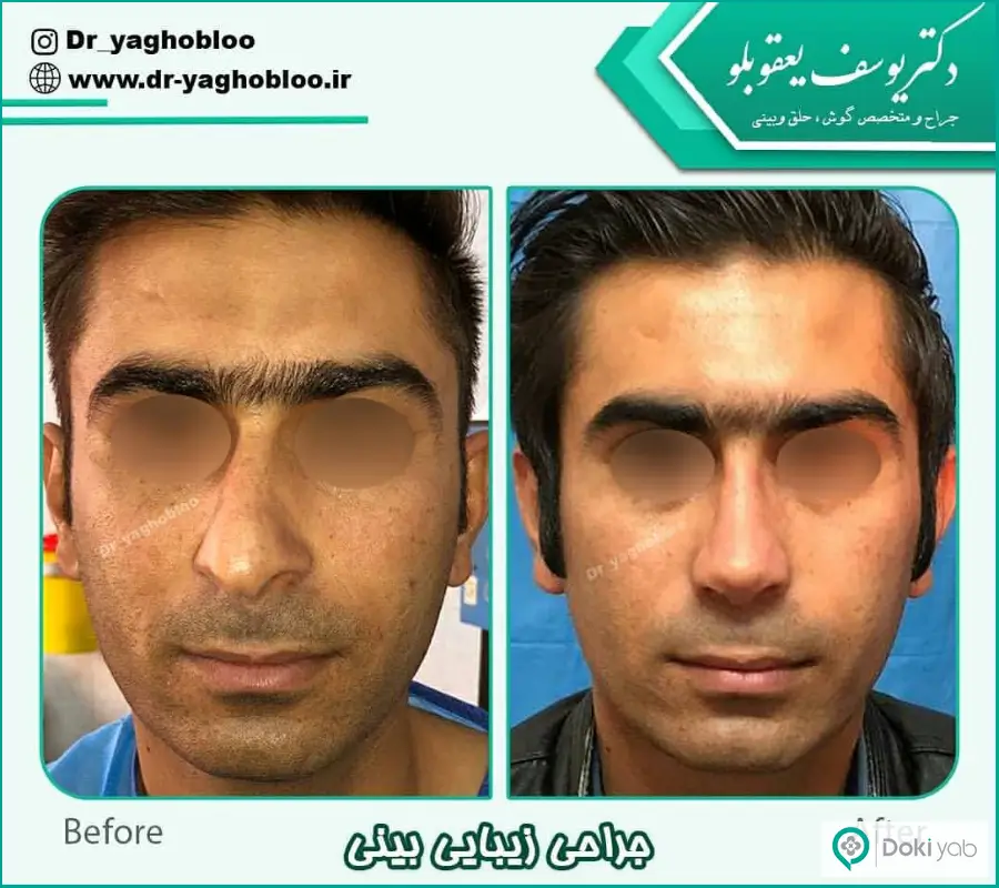 قبل و بعد عمل زیبایی بینی کوتاه مردانه دکتر یوسف یعقوبلو