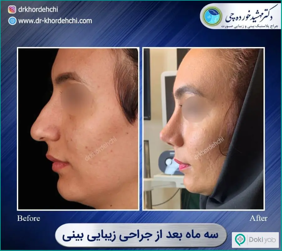 قبل و بعد رینوپلاستی زنانه دکتر مهشید خورده چی در اصفهان