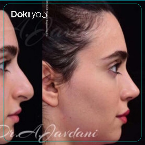نمونه جراحی بینی زنانه دکتر علی جاودانی 