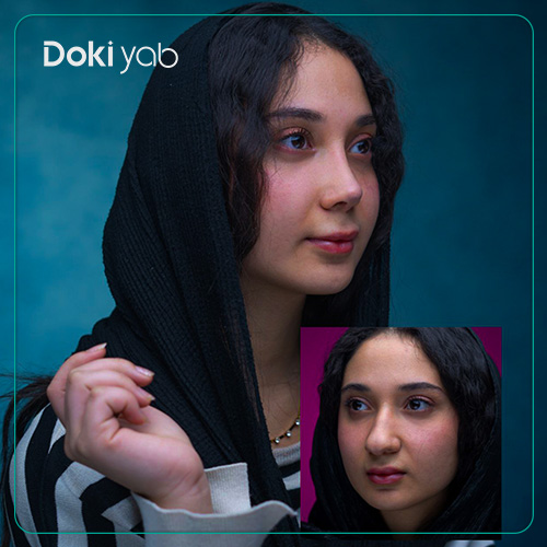 نمونه عمل بینی نیمه گوشتی دکتر سولماز قربانی