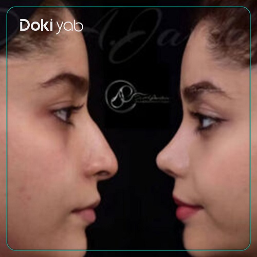 نمونه عمل بینی زنانه دکتر علی جاودانی 