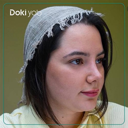 نمونه عمل بینی کج با مشاوره دکی یاب