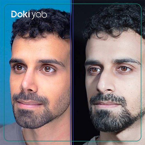 عمل بینی مردانه در شیراز با کمک تیم دکی یاب
