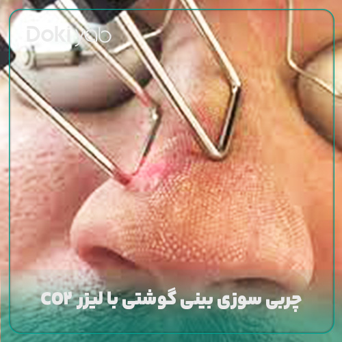 چربی سوزی بینی گوشتی با لیزر CO2 
