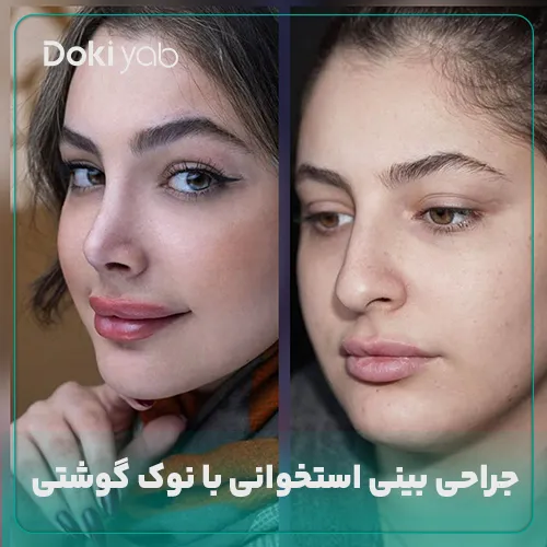 معرفی بهترین جراح بینی استخوانی با نوک گوشتی