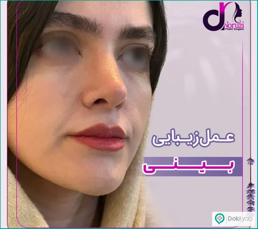 نمونه  عمل زیبایی بینی طبیعی زنانه دکتر عباس نوروزی