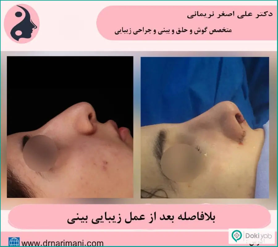 قبل و بعد جراحی بینی گوشتی سبک فانتزی دکتر علی اصغر نریمانی