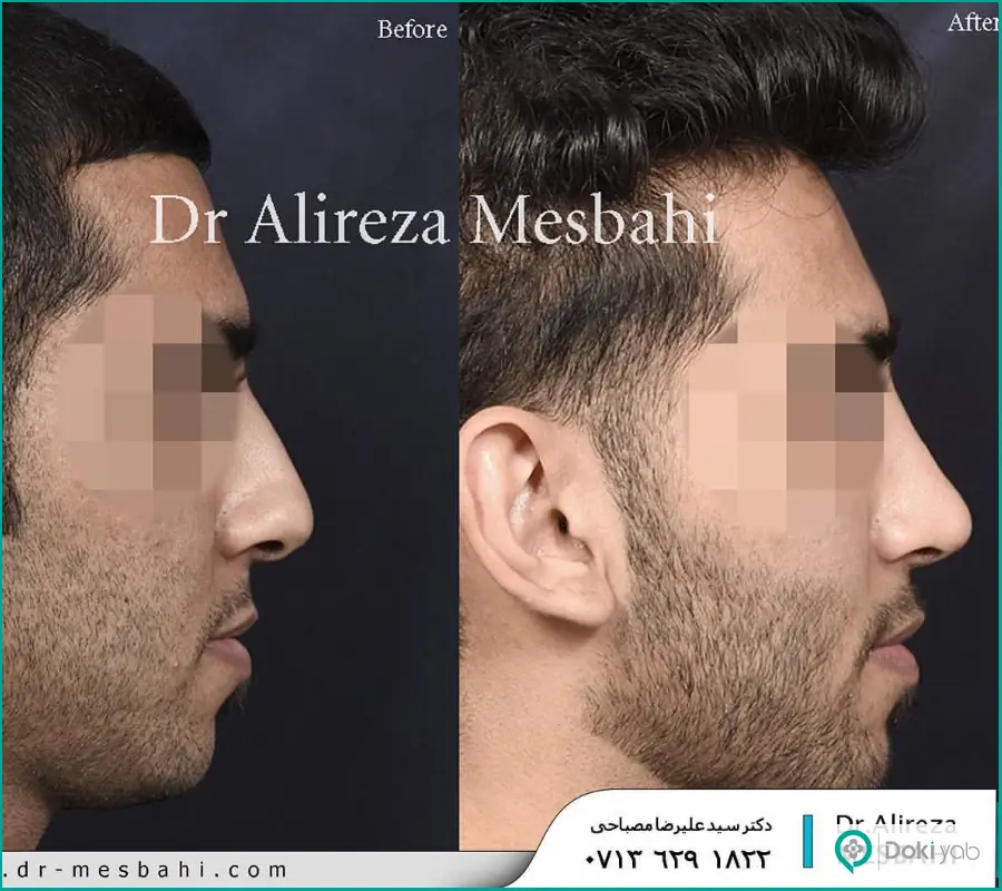 نمونه کار قبل و بعد عمل دماغ ترمیمی دکتر سید علیرضا مصباحی در شیراز