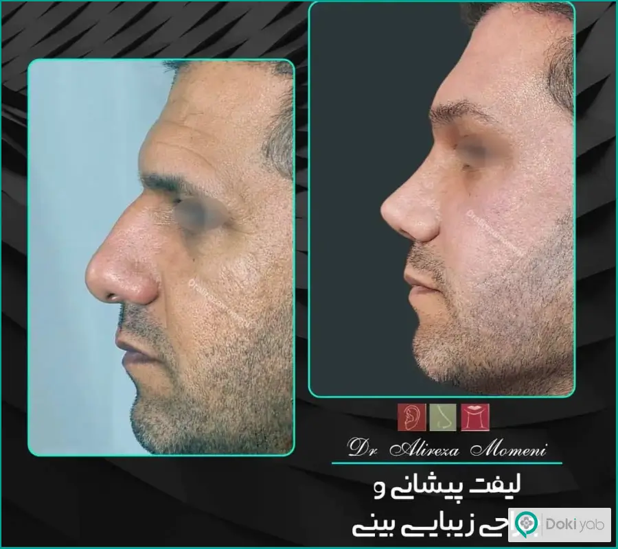 قبل و بعد جراحی زیبایی بینی عقابی مردانه دکتر علیرضا مومنی