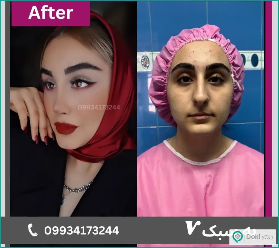 نمونه قبل و بعد عمل دماغ زنانه دکتر آرزو خوانساری در تهران