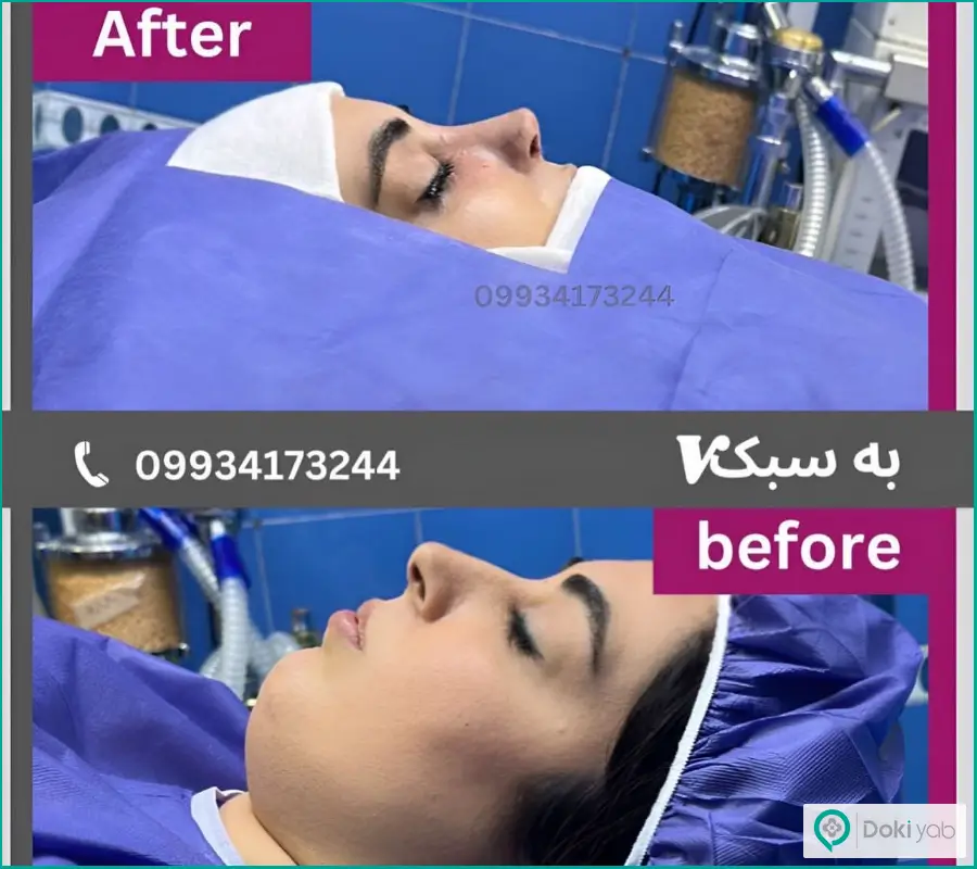 قبل و بعد عمل بینی زنانه دکتر آرزو خوانساری در تهران