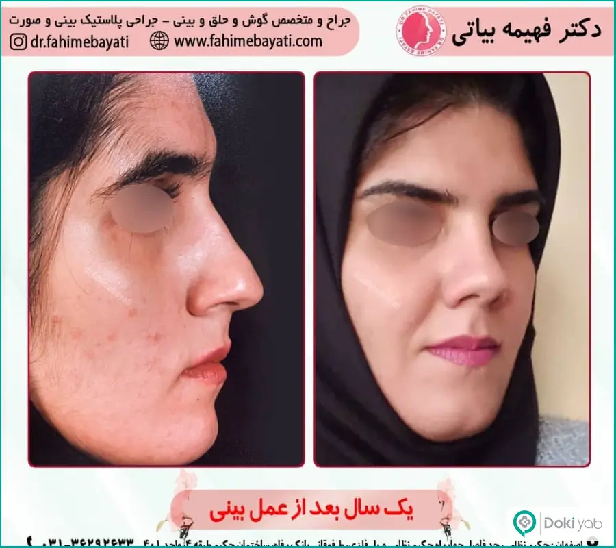 نمونه عمل جراحی دماغ زنانه دکتر فهیمه بیاتی در اصفهان