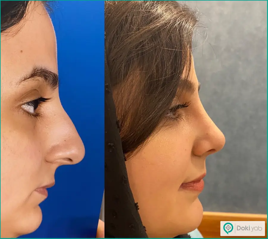 نمونه کار قبل و بعد جراحی بینی زنانه مدل طبیعی دکتر سید حمیدرضا باقری
