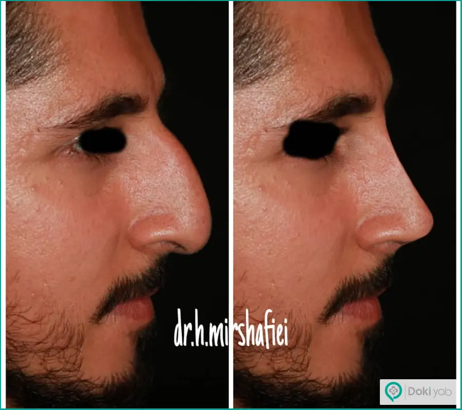 نمونه قبل و بعد جراحی عمل بینی نیمه فانتزی مردانه دکتر حسین میرشفیعی