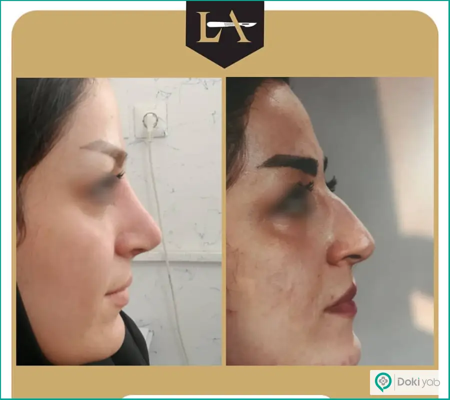 نمونه قبل و بعد عمل بینی ترمیمی زنانه دکتر لیلا اسدپور در شیراز