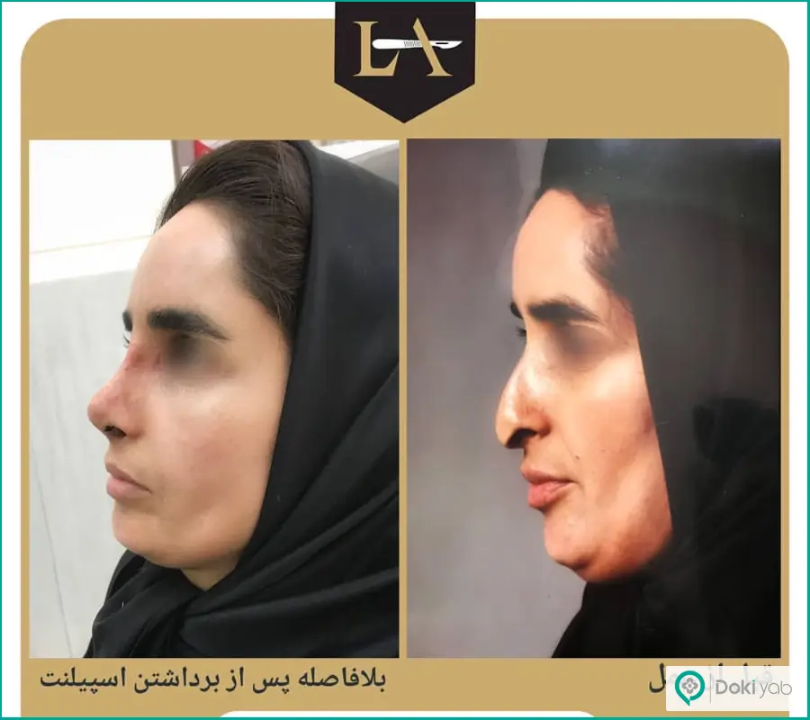 نمونه قبل و بعد جراحی دماغ ترمیمی زنانه دکتر لیلا اسدپور در شیراز