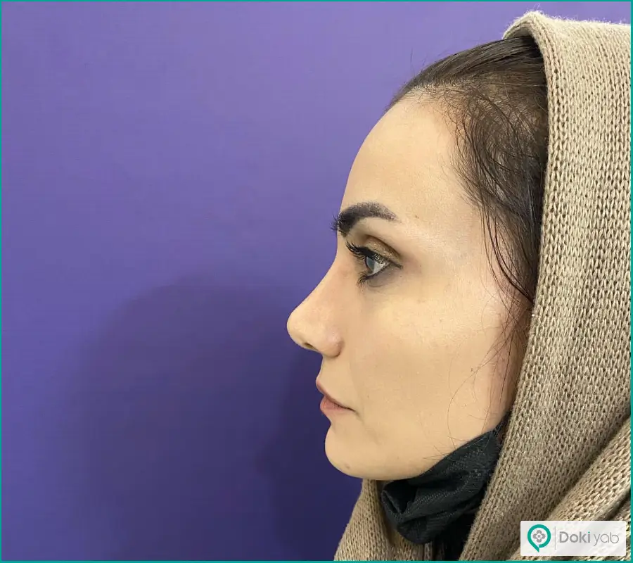 رینوپلاستی بینی عقابی زنانه دکتر محمد اکبریان
