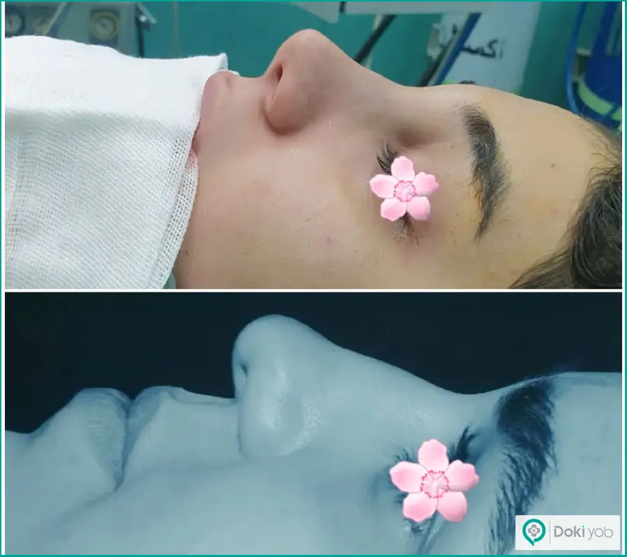  قبل و بعد عمل جراحی بینی دکتر محمدرضا شبیری در همدان