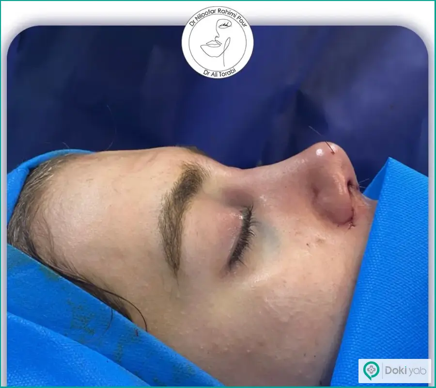 نمونه کار جراحی زیبایی بینی بزرگ استخوانی به روش باز دکتر نیلوفر رحیمی پور