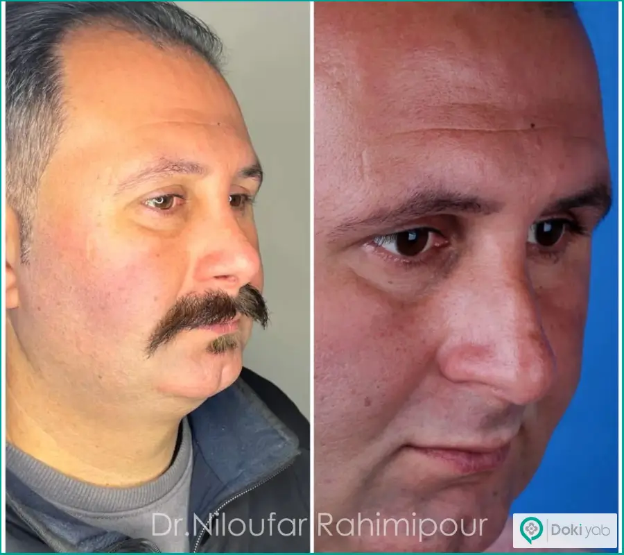 نمونه عمل جراحی بینی بزرگ استخوانی مردانه دکتر نیلوفر رحیمی پور
