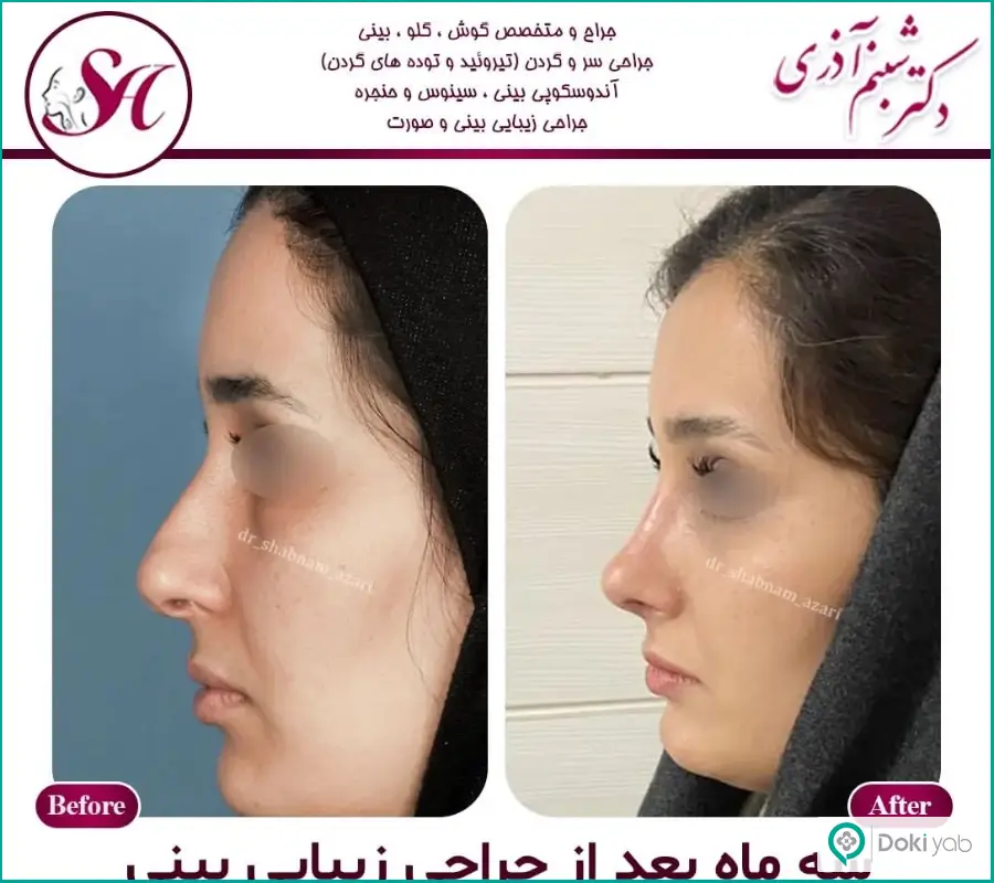 قبل و بعد جراحی زیبایی دماغ زنانه دکتر شبنم آذری در اصفهان