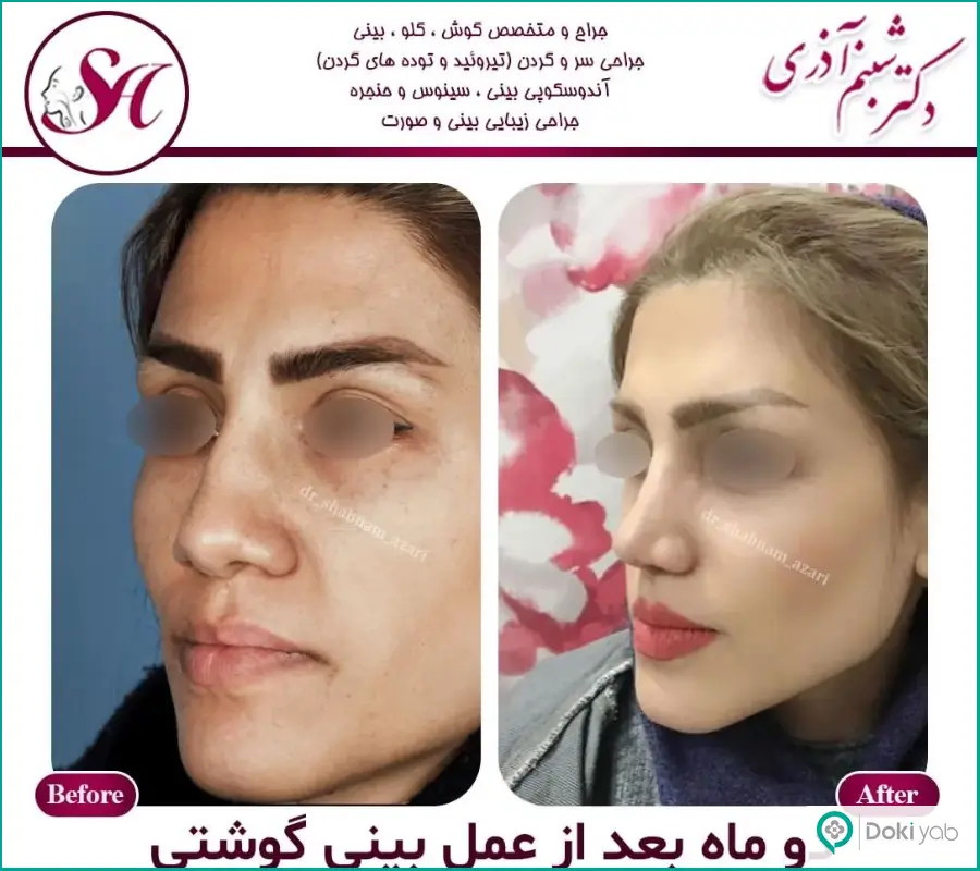 نمونه عمل جراحی بینی زنانه دکتر شبنم آذری در اصفهان