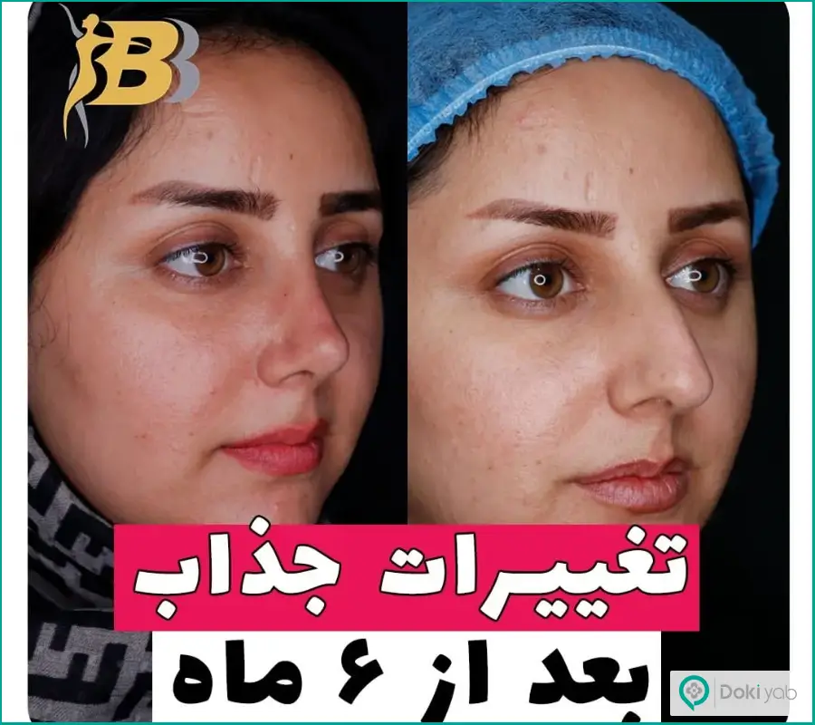 قبل و بعد عمل زیبایی دماغ گوشتی دکتر شبنم شادابی در تهران