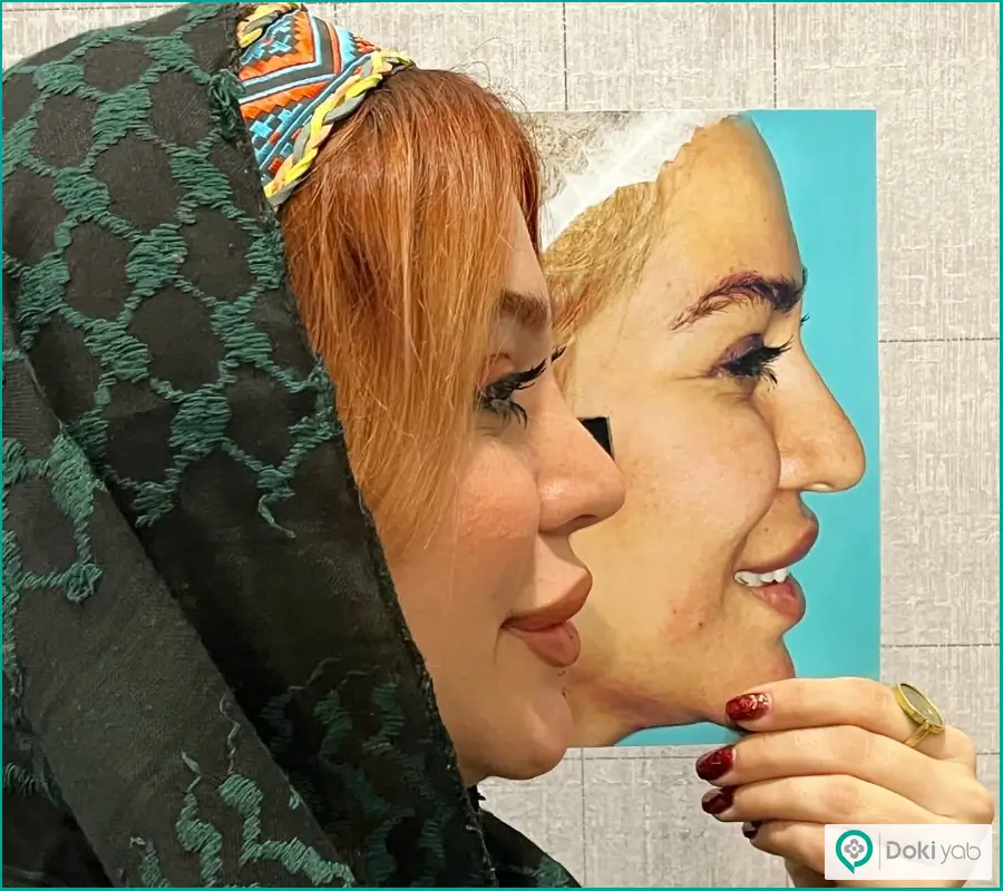 قبل و بعد عمل زیبایی بینی زنانه استخوانی با نوک گوشتی دکتر شایسته شهمیرزادی
