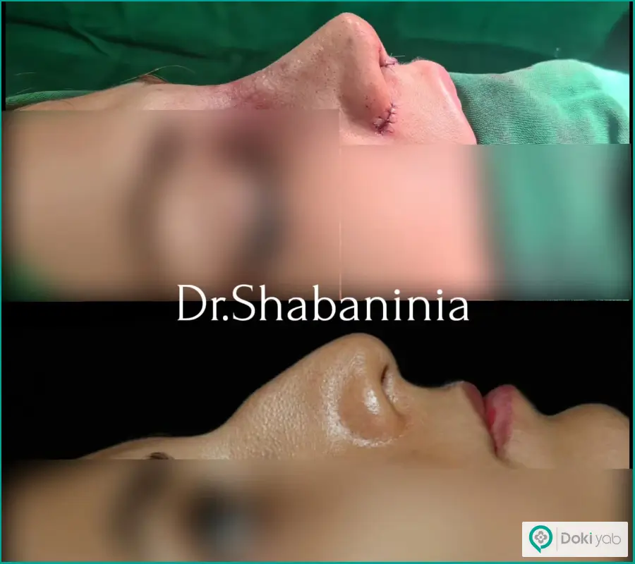 نمونه قبل و بعد عمل بینی استخوانی با نوک گوشتی زنانه دکتر شهریار شعبانی نیا