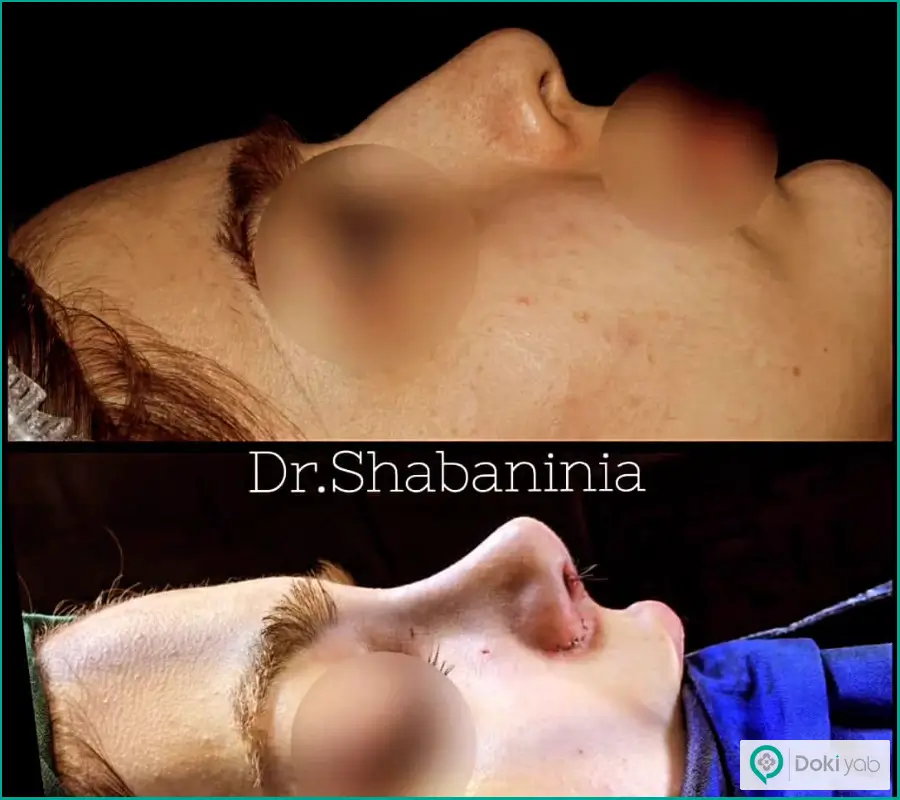 قبل و بعد جراحی بینی استخوانی با نوک گوشتی زنانه دکتر شهریار شعبانی نیا