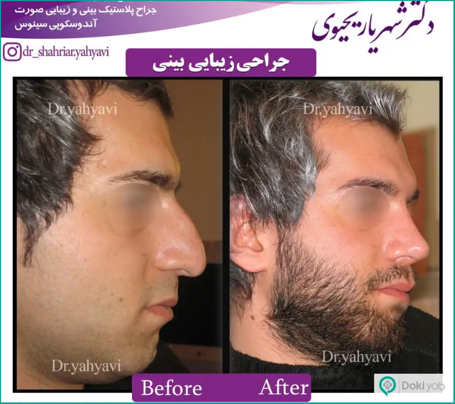 قبل و بعد عمل جراحی بینی مردانه به سبک فانتزی دکتر شهریار یحیوی
