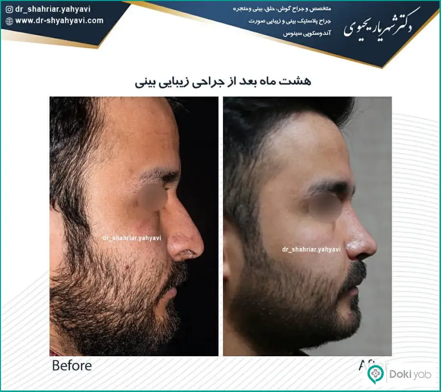 قبل و بعد عمل زیبایی بینی مردانه دکتر شهریار یحیوی