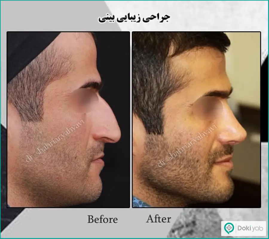 قبل و بعد رینوپلاستی نیمه فانتزی مردانه دکتر شهریار یحیوی